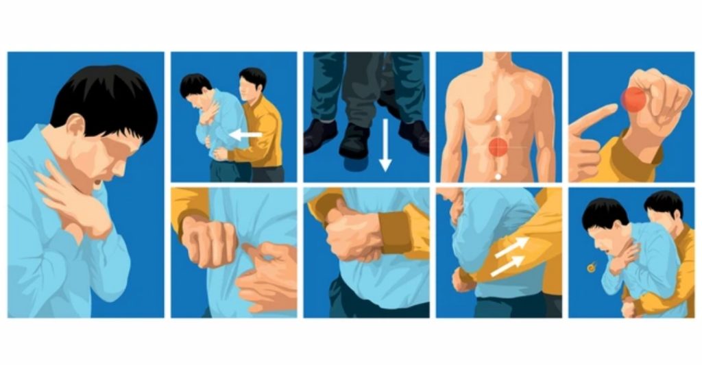 Hướng Dẫn Xử Lý Hóc Dị Vật Ở Người Lớn