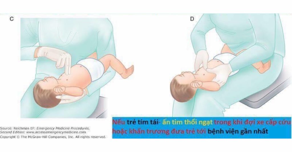 Hướng Dẫn Xử Lý Trẻ Dưới 2 Tuổi Hóc Dị Vật