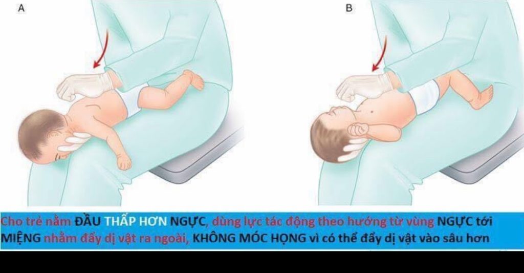 Hướng Dẫn Xử Lý Trẻ Dưới 2 Tuổi Hóc Dị Vật