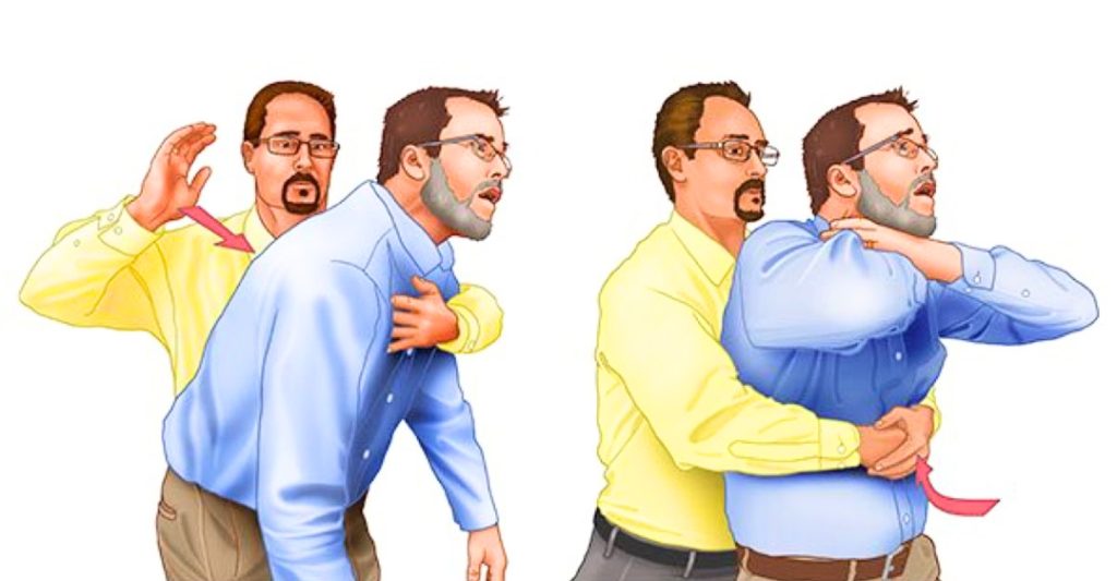 Heimlich Tư Thế Ngã Đầu Về Phía Trước