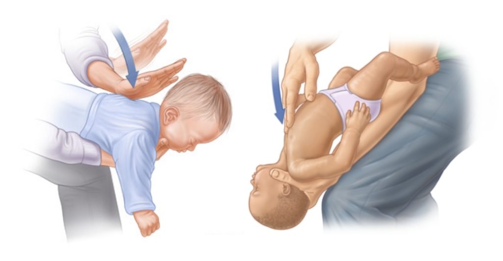 Sơ Cứu Hóc Dị Vật Ở Trẻ Nhỏ